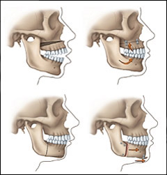 Jaw Surgery Arlington VA | Oral Surgery