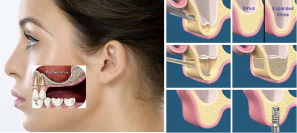 Sinus Lift And Augmentation Arlington Va Gainesville Vanova Surgical Art 7180